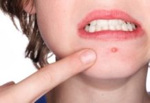 Jerawat Selama Self Quarantine? ini Tips Mengatasi dengan Bahan Alami di Rumah