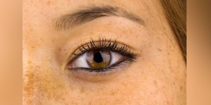 Flek Hitam Flek Hitam